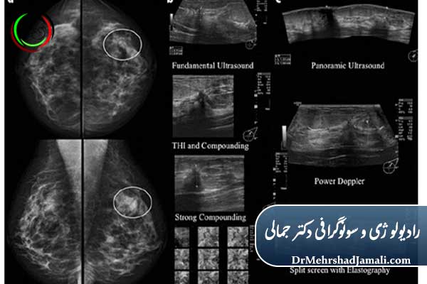 تفاوت ماموگرافی و سونوگرافی پستان