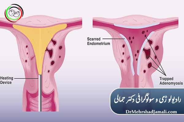 اندومتریوز چیست؟
