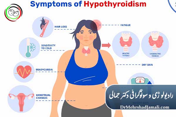 کم‌کاری تیروئید در زنان