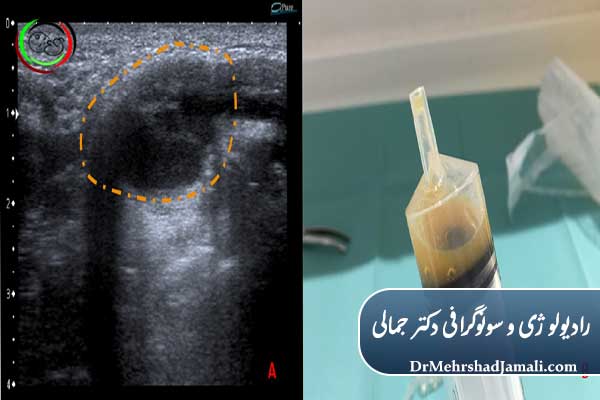 مزایای آسپیراسیون کیست نسبت به جراحی