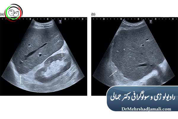 نقش سونوگرافی در تشخیص و بررسی سیروز کبدی