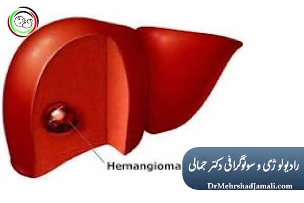  انجام اسکلروتراپی همانژیوم کبد در مرکز تصویربرداری دکتر مهرشاد جمالی
