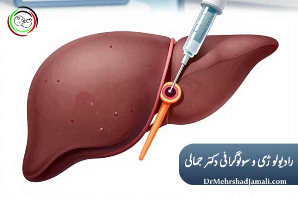 اسکلروتراپی کیست هیداتیک چیست؟