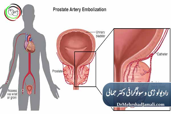  آمبولیزاسیون پنیس چیست؟