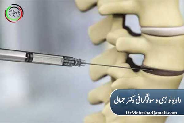 تزریق ژل دیسک کمر