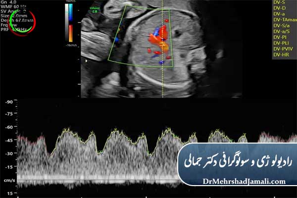 سونوگرافی داپلر بارداری