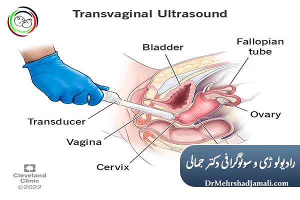 سونوگرافی واژینال چیست؟