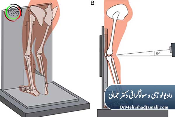انواع عکس زانو