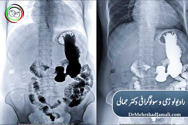 عکس رنگی معده چیست؟