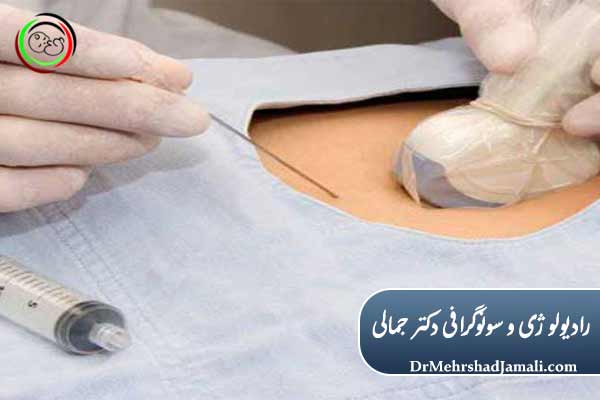 اسکلروتراپی چیست و چگونه عمل می‌کند؟