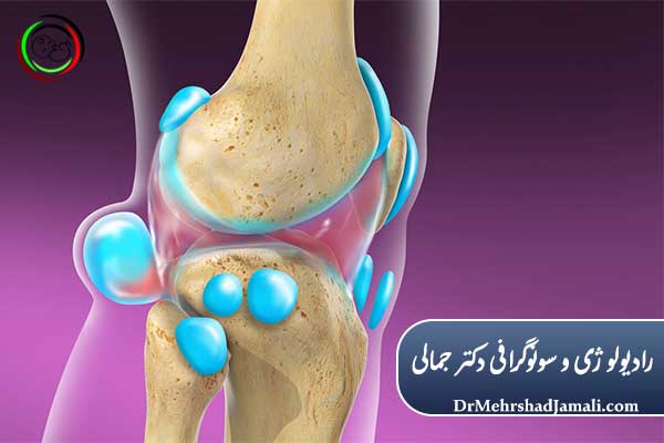 درمان بیکر سیست