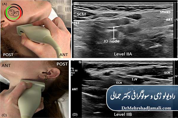 موارد تجویز سونوگرافی غدد لنفاوی