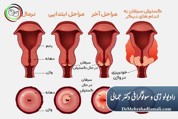 علائم سرطان دهانه رحم