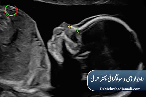 NB مخفف Nasal Bone به معنای استخوان بینی
