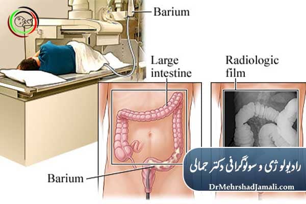 عکس رنگی روده چیست؟