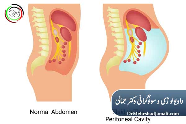 آیا کاتترگذاری آسیت خطرناک است؟