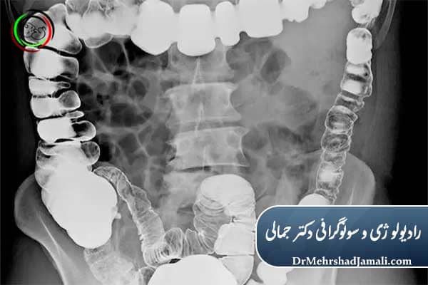 تشخیص بیماری با عکس رنگی روده