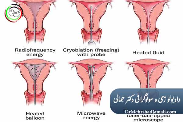 الیشن (Ablation) اندومتریوز