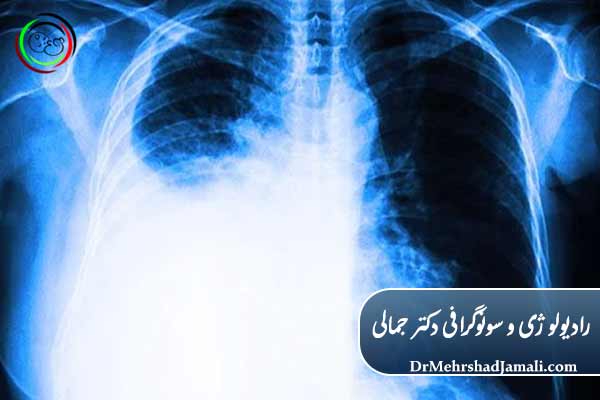 عکس ساده ریه ( x-ray ریه )