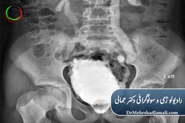 VCUG سیستوگرافی چیست؟