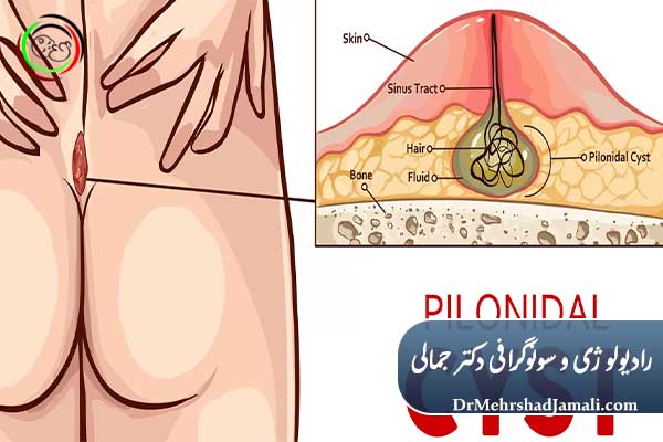 کیست مویی یا سینوس پیلونیدال