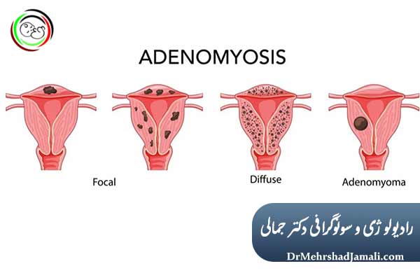 علائم بالینی آدنومیوز رحم چیست ؟