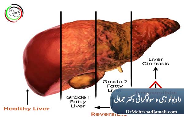علل و عوامل خطر ابتلا به کبد چرب گرید ۱