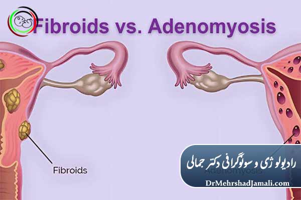تفاوت آدنومیوز با فیبروم در سونوگرافی
