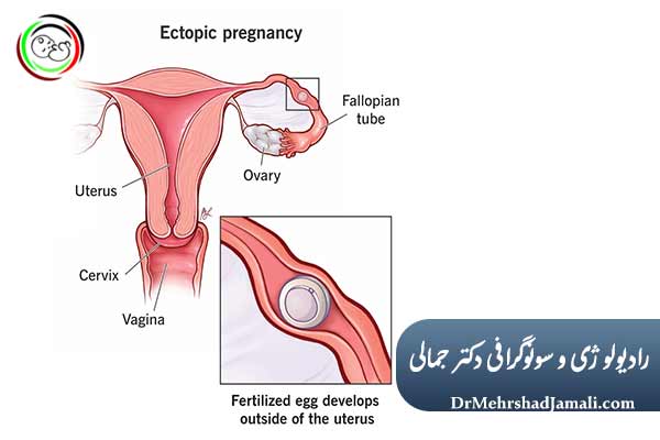 علائم هشداردهنده بارداری خارج از رحم