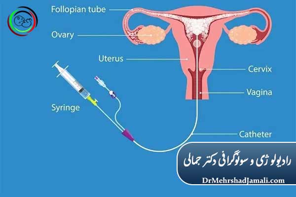 عکس رنگی رحم (HSG)