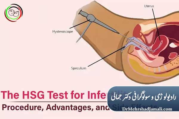 مدت زمان و درد HSG