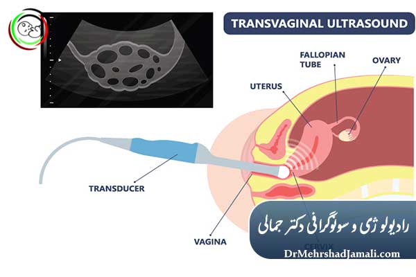 تفاوت سونوگرافی ترانس‌ابدومینال با ترانس‌واژینال