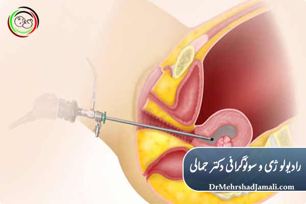 بقایای بارداری