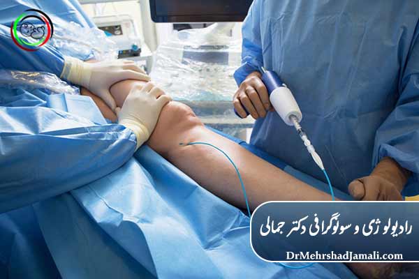  اسکلروتراپی واریس با فوم