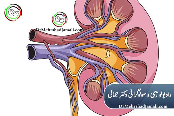 تشخیص سنگ‌های کلیه