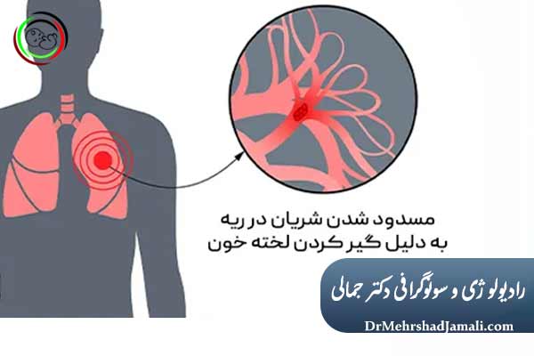 علائم شایع آمبولی ریه