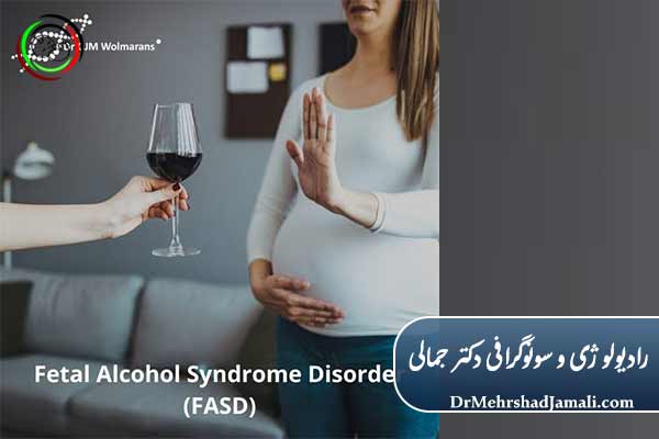 تشخیص زودهنگام سندرم الکل جنینی