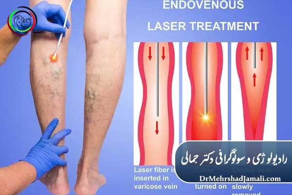 لیزر واریس چیست؟