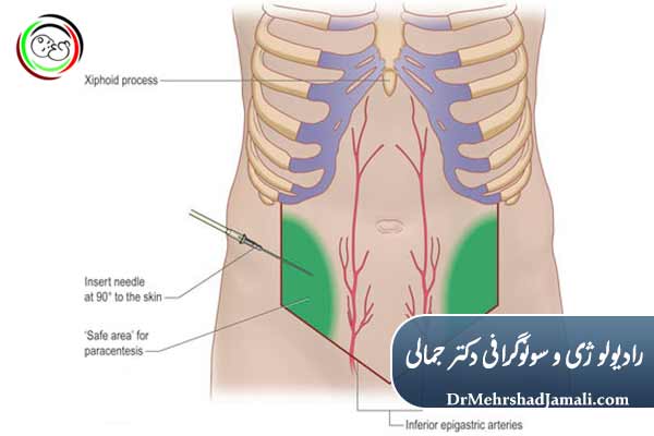 مراحل کاتترگذاری مایع آسیت 