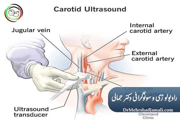 شریان‌های کاروتید (Carotid Doppler)