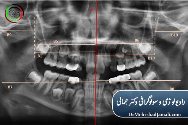 چرا عکس دندان برای کودکان لازم است؟