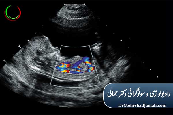 اکو قلب جنین