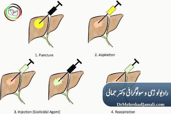 درمان قطعی کیست هیداتید بدون جراحی؛ روش PAIR  چیست ؟