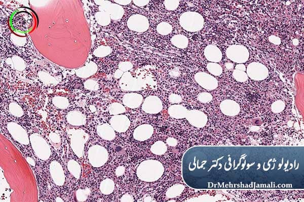 تفاوت آسپیراسیون و بیوپسی مغز استخوان