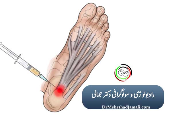 تزریق PRP برای خارپاشنه