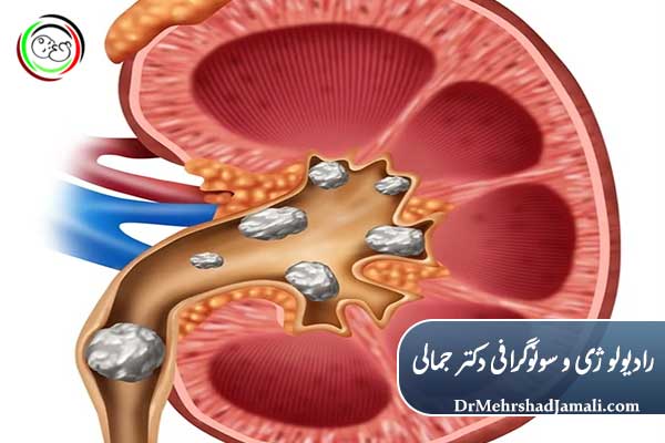 علائم سنگ کلیه