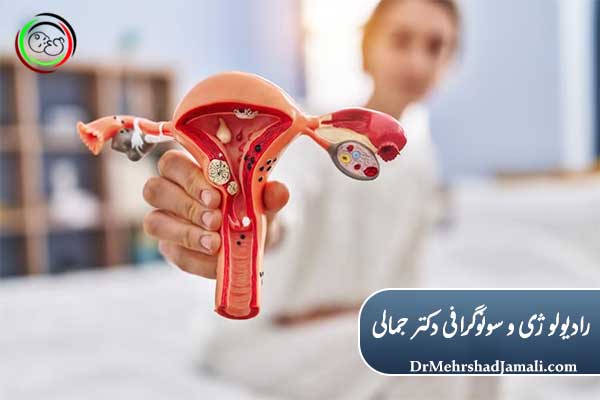 علت‌های تنبلی تخمدان