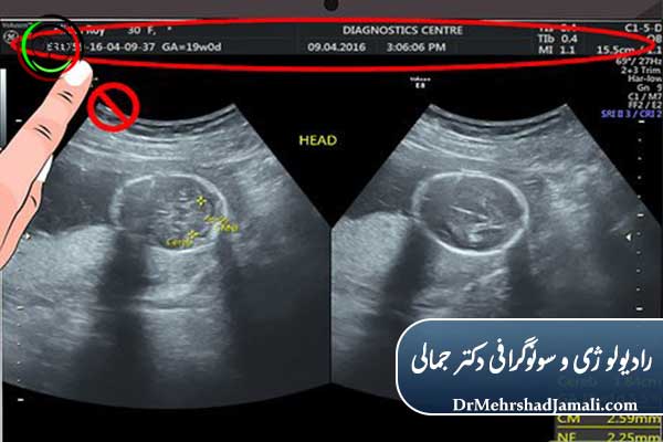 اصطلاحات رایج در تفسیر سونوگرافی بارداری