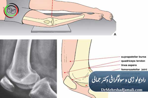 مراحل انجام عکس زانو