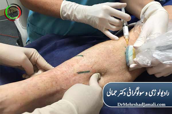 اسکلروتراپی با هدایت سونوگرافی